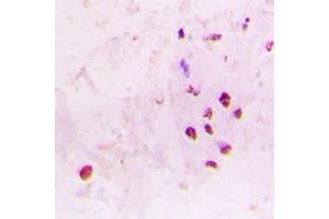 Immunohistochemical analysis of RAD17 staining in human lung cancer formalin fixed paraffin embedded tissue section. (RAD17 antibody  (C-Term))