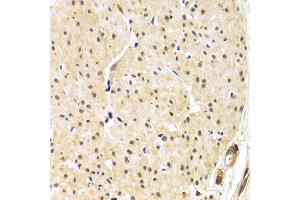 Immunohistochemistry of paraffin-embedded human gastric cancer using TERF1 antibody (ABIN6292425) at dilution of 1:200 (40x lens).