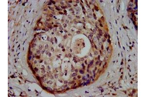 IHC image of ABIN7154126 diluted at 1:500 and staining in paraffin-embedded human cervical cancer performed on a Leica BondTM system. (Glutathione Synthetase antibody  (AA 290-418))