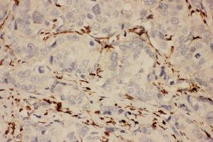 Anti-COX1 Picoband antibody,  IHC(P): Human Mammary Cancer Tissue (PTGS1 antibody  (AA 318-599))