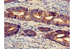 Immunohistochemistry of paraffin-embedded human colon cancer using ABIN7174508 at dilution of 1:100