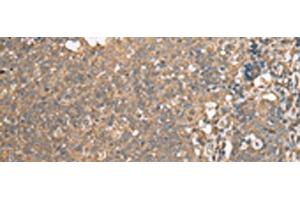 Immunohistochemistry of paraffin-embedded Human cervical cancer tissue using ECI1 Polyclonal Antibody at dilution of 1:30(x200) (DCI antibody)