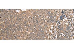 Immunohistochemistry of paraffin-embedded Human cervical cancer tissue using ECI1 Polyclonal Antibody at dilution of 1:30(x200)