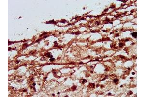 IHC image of ABIN7162742 diluted at 1:500 and staining in paraffin-embedded human melanoma performed on a Leica BondTM system. (SLC26A4 antibody  (AA 592-655))