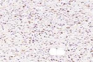 Immunohistochemistry analysis of paraffin-embedded human gastric cancer using NMU (ABIN7074818) at dilution of 1: 1000 (Neuromedin U antibody)