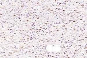 Immunohistochemistry analysis of paraffin-embedded human gastric cancer using NMU (ABIN7074818) at dilution of 1: 1000