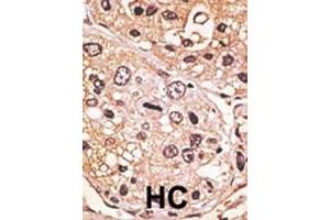 Formalin-fixed and paraffin-embedded human cancer tissue reacted with the primary antibody, which was peroxidase-conjugated to the secondary antibody, followed by AEC staining. (GDF9 antibody  (N-Term))