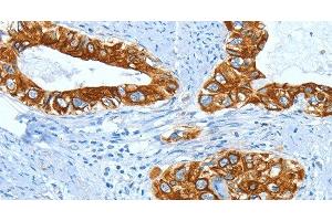 Immunohistochemistry of paraffin-embedded Human cervical cancer using KRT40 Polyclonal Antibody at dilution of 1:50 (KRT40 antibody)