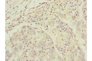 Immunohistochemistry of paraffin-embedded human liver cancer using ABIN7148369 at dilution of 1:100 (C8A antibody  (AA 310-460))
