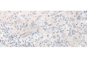Immunohistochemistry of paraffin-embedded Human cervical cancer tissue using TIMM8A Polyclonal Antibody at dilution of 1:50(x200) (TIMM8A/DDP antibody)
