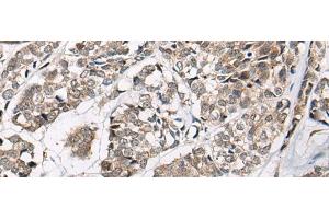 Immunohistochemistry of paraffin-embedded Human esophagus cancer tissue using CACNB3 Polyclonal Antibody at dilution of 1:55(x200) (CACNB3 antibody)