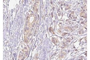ABIN6267430 at 1/100 staining human breast carcinoma tissue sections by IHC-P. (NFKB1 antibody  (pSer337))