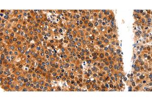 Immunohistochemistry of paraffin-embedded Human liver cancer tissue using FGFR1 Polyclonal Antibody at dilution 1:60 (FGFR1 antibody)
