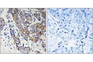 Immunohistochemistry analysis of paraffin-embedded human breast carcinoma tissue, using CBR1 Antibody.
