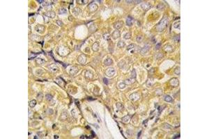 IHC analysis of FFPE human prostate carcinoma tissue stained with TRPM8 antibody (TRPM8 antibody  (AA 521-552))