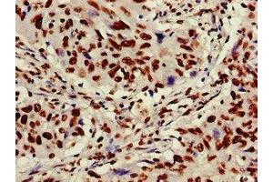 Immunohistochemistry of paraffin-embedded human lung cancer using ABIN7175905 at dilution of 1:100 (XRCC6 antibody  (AA 2-609))