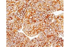Formalin-fixed, paraffin-embedded human colon carcinoma stained with Cytokeratin 18 antibody. (Cytokeratin 18 antibody)