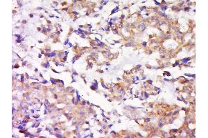 Paraformaldehyde-fixed, paraffin embedded human lung carcinoma, Antigen retrieval by boiling in sodium citrate buffer (pH6) for 15min, Block endogenous peroxidase by 3% hydrogen peroxide for 30 minutes, Blocking buffer (normal goat serum) at 37°C for 20min, Antibody incubation with Rabbit Anti-MEK1/2 Polyclonal Antibody, Unconjugated  at 1:500 overnight at 4°C, followed by a conjugated secondary and DAB staining. (MEK1/2 antibody  (AA 301-393))
