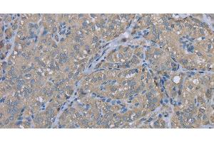 Immunohistochemistry of paraffin-embedded Human thyroid cancer using EZR Polyclonal Antibody at dilution of 1:30 (Ezrin antibody)