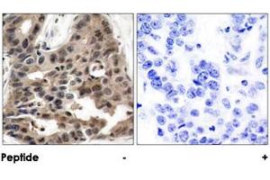Immunohistochemical analysis of paraffin-embedded human breast carcinoma tissue using EIF4EBP1 polyclonal antibody . (eIF4EBP1 antibody)