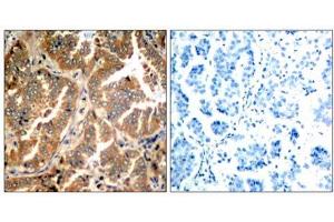 Immunohistochemical analysis of paraffin- embedded human lung carcinoma tissue using ADD1 (Ab-726) antibody (E021189).