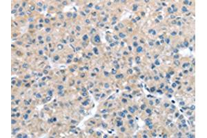 The image on the left is immunohistochemistry of paraffin-embedded Human liver cancer tissue using ABIN7127970(ITPA Antibody) at dilution 1/25, on the right is treated with fusion protein. (ITPA antibody)