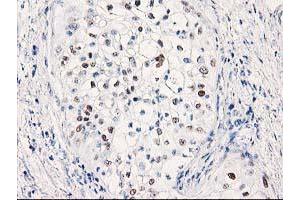 Immunohistochemistry (IHC) image for anti-Tumor Protein P53 (TP53) antibody (ABIN1499971) (p53 antibody)
