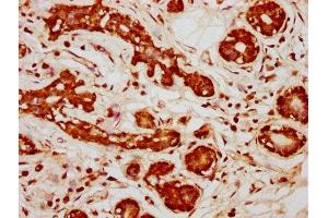 IHC image of ABIN7169260 diluted at 1:333 and staining in paraffin-embedded human breast cancer performed on a Leica BondTM system. (PPP2R1B antibody  (Regulatory Subunit A))