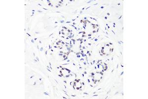Immunohistochemistry of paraffin-embedded human breast using MonoMethyl-Histone H3-R17 antibody (ABIN3017467, ABIN3017468, ABIN3017469 and ABIN6220100) at dilution of 1:100 (40x lens). (Histone 3 antibody  (H3R17me))