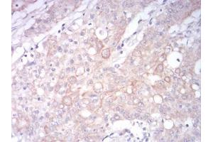 Immunohistochemical analysis of paraffin-embedded stomach cancer tissues using LRP1 mouse mAb with DAB staining.