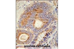 HHAT Antibody (N-term) (ABIN651694 and ABIN2840363) immunohistochemistry analysis in formalin fixed and paraffin embedded human prostate carcinoma followed by peroxidase conjugation of the secondary antibody and DAB staining. (HHAT antibody  (N-Term))