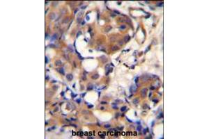 KNG1 Antibody immunohistochemistry analysis in formalin fixed and paraffin embedded human breast carcinoma followed by peroxidase conjugation of the secondary antibody and DAB staining.