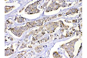 MUT was detected in paraffin-embedded sections of human lung cancer tissues using rabbit anti- MUT Antigen Affinity purified polyclonal antibody (Catalog # ) at 1 µg/mL. (MUT antibody  (N-Term))