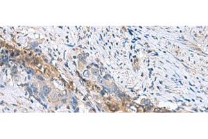 Immunohistochemistry of paraffin-embedded Human cervical cancer tissue using RNF208 Polyclonal Antibody at dilution of 1:55(x200) (RNF208 antibody)