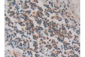 IHC-P analysis of Human Stomach cancer Tissue, with DAB staining.
