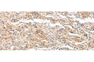 Immunohistochemistry of paraffin-embedded Human cervical cancer tissue using TTC12 Polyclonal Antibody at dilution of 1:40(x200) (TTC12 antibody)