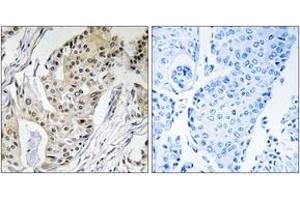Immunohistochemistry analysis of paraffin-embedded human breast carcinoma tissue, using POLE4 Antibody.