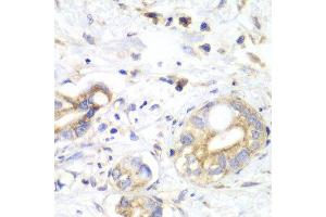 Immunohistochemistry of paraffin-embedded human liver cancer using TXN2 antibody at dilution of 1:100 (x40 lens). (TXN2 antibody)