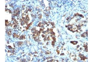 Formalin-fixed, paraffin-embedded human Gastric carcinoma stained with CDC20 Monoclonal Antibody (CDC20/1102) (CDC20 antibody)