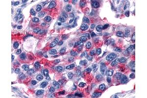 Anti-GPR80 / GPR99 / OXGR1 antibody IHC of human Lung, Non-Small Cell Carcinoma. (OXGR1 antibody  (Extracellular Domain))