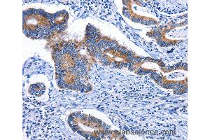 Immunohistochemistry of Human colon cancer using STAT5A Polyclonal Antibody at dilution of 1:25 (STAT5A antibody)