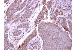 IHC-P Image CXCR1 antibody [C2C3], C-term detects CXCR1 protein at cytosol on human breast carcinoma by immunohistochemical analysis. (CXCR1 antibody  (C-Term))
