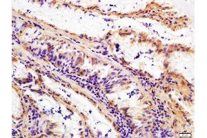 Paraformaldehyde-fixed, paraffin embedded human gastric cancer, Antigen retrieval by boiling in sodium citrate buffer (pH6) for 15min, Block endogenous peroxidase by 3% hydrogen peroxide for 30 minutes, Blocking buffer (normal goat serum) at 37°C for 20min, Antibody incubation with Rabbit Anti-FAPA Polyclonal Antibody, Unconjugated  at 1:200 overnight at 4°C, followed by a conjugated secondary for 90 minutes and DAB staining. (FAP antibody  (AA 311-410))