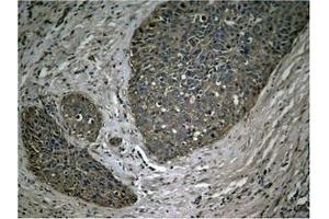 Immunohistochemical analysis of paraffin-embedded human breast carcinoma tissue using NFκB-p65 (Phospho-Ser536) Antibody. (NF-kB p65 antibody  (pSer536))