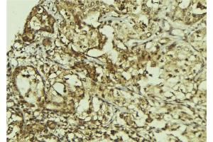 ABIN6267168 at 1/100 staining Human breast cancer tissue by IHC-P.