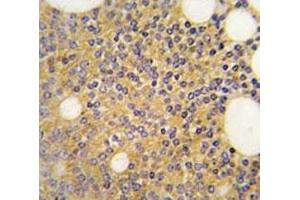IHC analysis of FFPE human prostate carcinoma tissue stained with PRMT3 antibody (PRMT3 antibody  (AA 460-491))