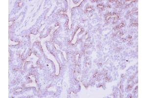 IHC-P Image Immunohistochemical analysis of paraffin-embedded human breast cancer, using CDO, antibody at 1:250 dilution. (CDON antibody  (N-Term))