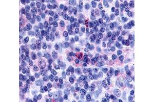 Anti-GPR65 antibody  ABIN1048859 IHC staining of human lymph node, hodgkin's disease. (GPR65 antibody  (Cytoplasmic Domain))