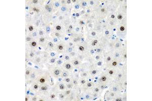 Immunohistochemistry of paraffin-embedded human liver cancer using LMX1B antibody (ABIN5975264) at dilution of 1/200 (40x lens). (LMX1B antibody)