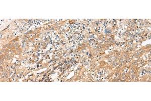 Immunohistochemistry of paraffin-embedded Human cervical cancer tissue using GALP Polyclonal Antibody at dilution of 1:45(x200) (GALP antibody)